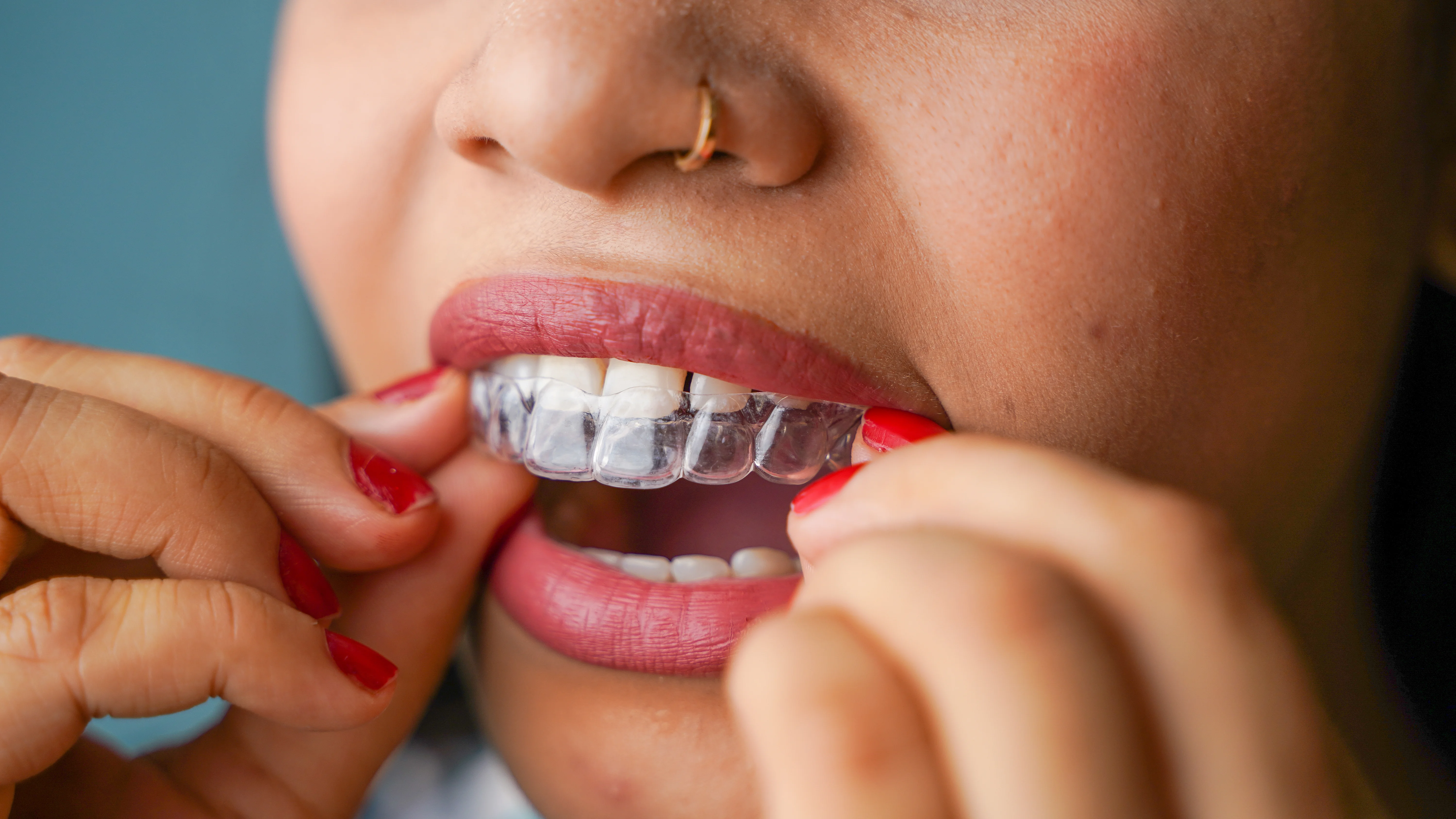 Invisalign Zahnkorrektur Bielefeld